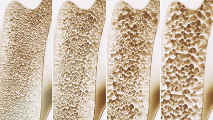 Osteoporosis 4 stages - 3d rendering - obrazy, fototapety, plakaty