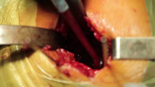 Reaming tool using during the hip replacement surgery (compound, 1080p, 25fps, sound)