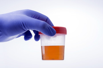Medical Urine Specimen Jar