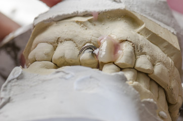 Dental technician doing partial dentures of acrylic resins.