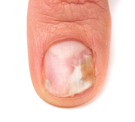 Fototapeta premium one finger of the hand with a fungus on the nails isolated white background