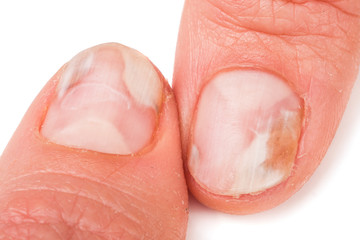 two fingers of the hand with a fungus on the nails isolated white background