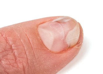 one finger of the hand with a fungus on the nails isolated white background