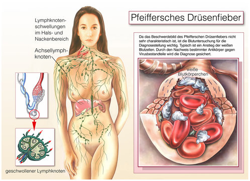 Pfeiffersches Dr&uuml;senfieber.Geschwollener Lymphknoten