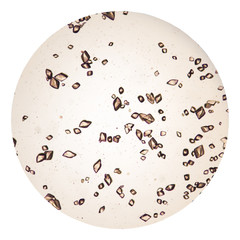 Uric acid crystal in urine sediment.