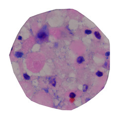 Cancer Cell in human showing abnormal cells.