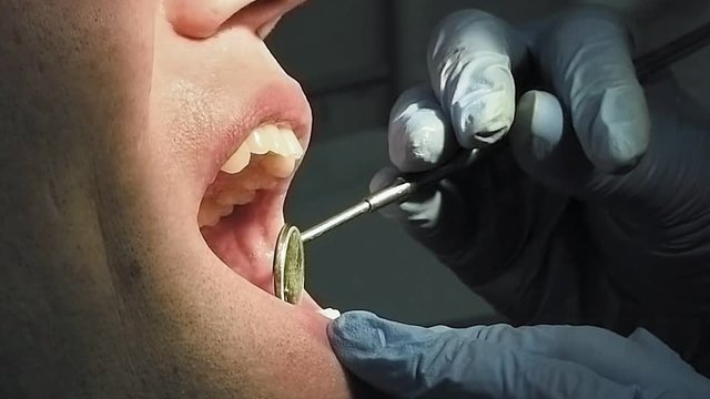 Middle age man gets medical mouth examination and treatment at the dentist clinic office. Dental health is important part of modern human life. Slow motion video footage.