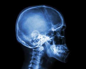 Film x-ray skull and cervical spine lateral view