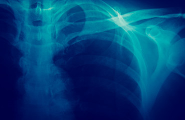X-ray
