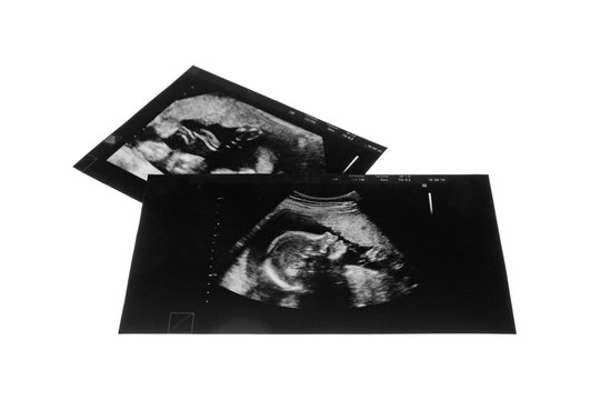 Ultrasound pictures of baby on white background