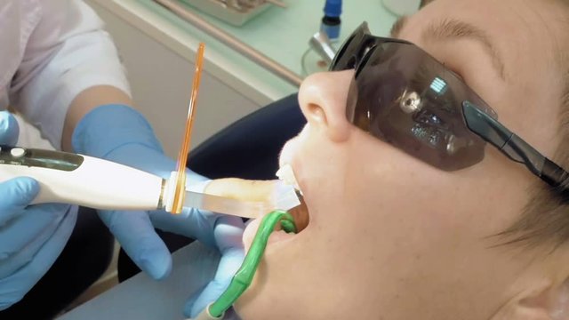 Woman at dentist clinic gets dental treatment to fill a cavity in a tooth. Dental restoration and material polymerization with UV light. Odontic and mouth health is real protection from caries decay.