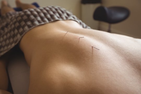 Close-up of a patient getting dry needling