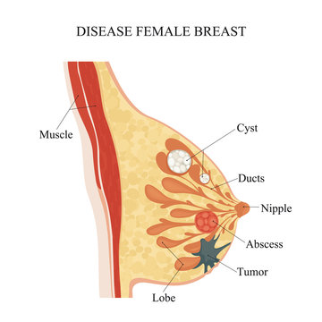 Disease female breast