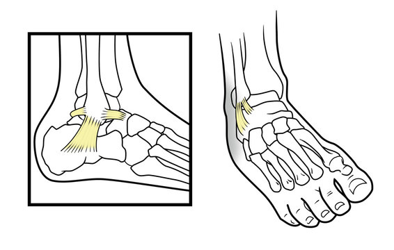 Dislocation of ankle, Dislocated ankle diagram on a white background