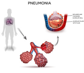 Pneumonia illustration, human silhouette with lungs, close up of alveoli and inflamed alveoli with fluid inside.