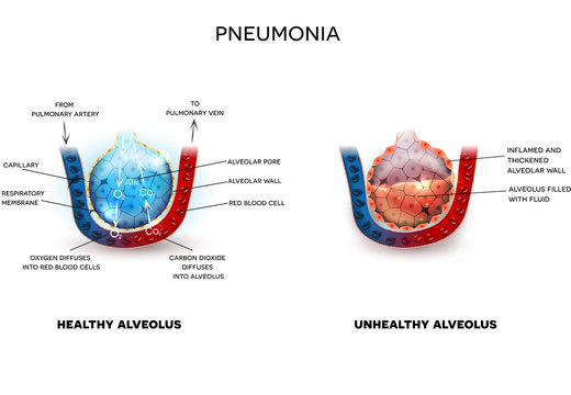 Pneumonia Illustration, Alveoli With Fluid And Healthy Alveoli, Oxygen And Carbon Dioxide Exchange Between Alveoli And Capillaries.