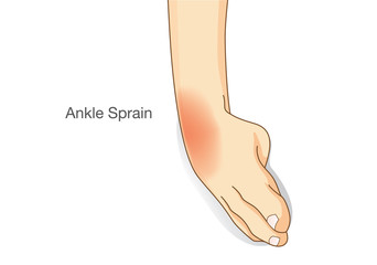 Ankle sprain and swelled. This illustration about common foot injuries. - obrazy, fototapety, plakaty