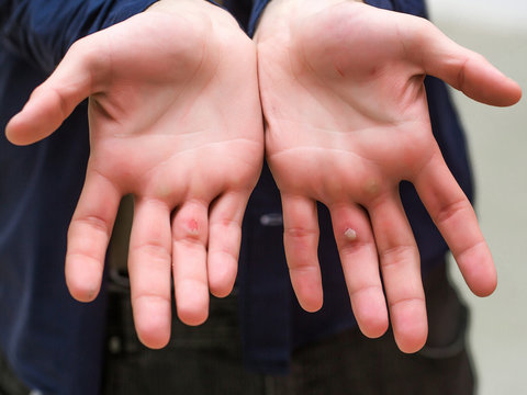 Hands With Blister And Callus