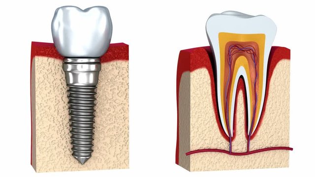 Anatomy of healthy teeth and dental implant in jaw bone. 3D animation.