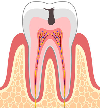 虫歯　断面図