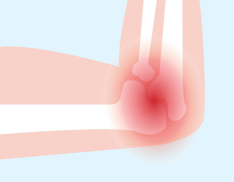 illustration vector of elbow bone and joint pain