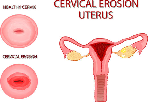 Uterus. Cervical Erosion