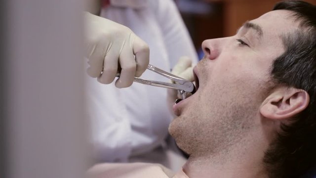 Dentist pull out tooth at dental clinic.