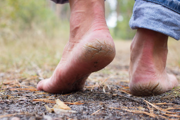 Close up photo pair of cracked heels. Male back view.