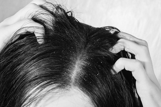 Dander That Causes Itching Scalp