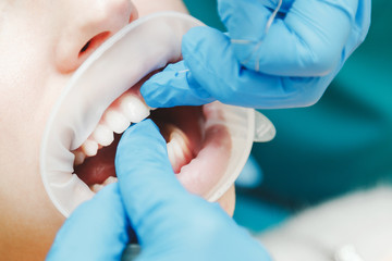 Fototapeta premium Close up of female mouth with retractor. Doctor flossing the teeth