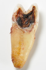 Tooth Decay