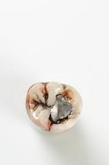 Tooth Decay