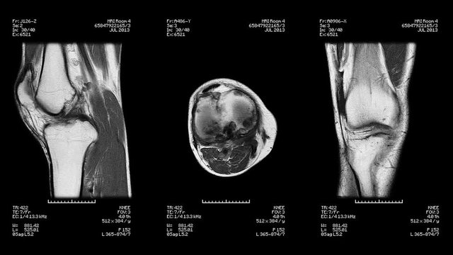 Knee Mri Scan. Loopable. Black and white.