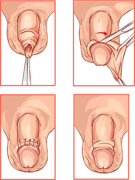    illustration of circumcision of the foreskin of the penis