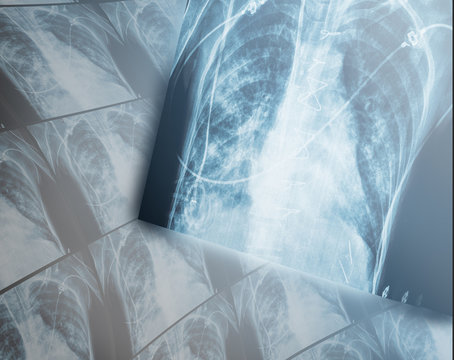 Heavy destructive changes in the lungs of the patients x-ray.