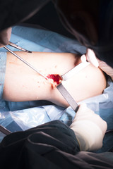 Surgical operation knee surgery