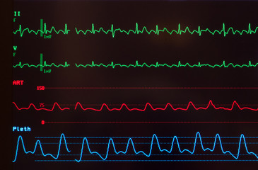 Close up of a medical monitor with green lines of the ECG showing atrial flutter a red line showing the arterial blood pressure and the blue line showing the oxygen saturation level.