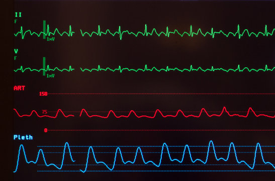 Close up of a medical monitor with green lines of the ECG showing atrial flutter a red line showing the arterial blood pressure and the blue line showing the oxygen saturation level.