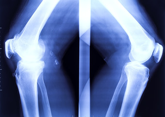 X-ray of the two bended knees