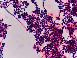 Branching budding yeast cells with pseudohyphae in  gram stain f