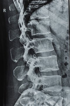 x-rays of the spine