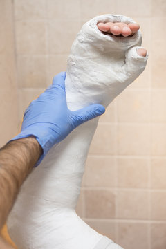 Orthopedic technician putting on a fiberglass  plaster cast
