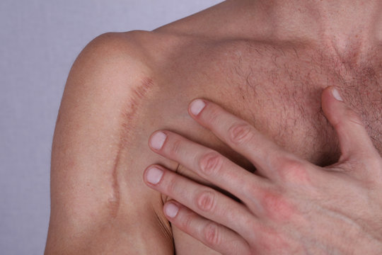 Man man with scar on his shoulder. Laser Scar Reduction concept