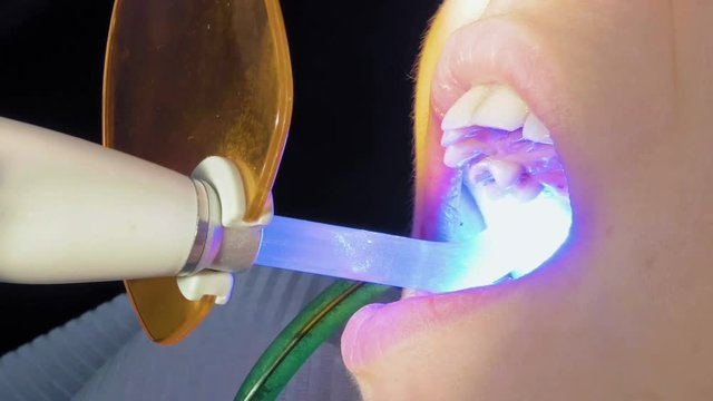 Woman at dentist clinic gets dental treatment to fill a cavity in a tooth. Dental restoration and material polymerization with UV light. Odontic and mouth health is real protection from caries decay.