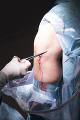 Surgical operation knee surgery