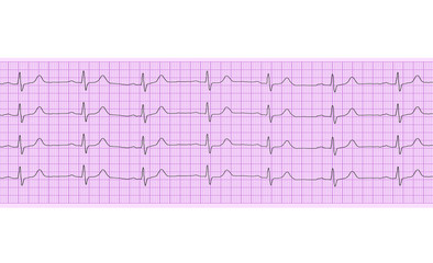 Heart analysis, electrocardiogram graph (ECG)