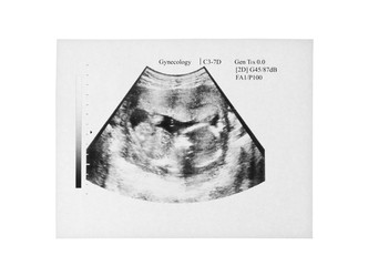 Ultrasound picture of baby on white background
