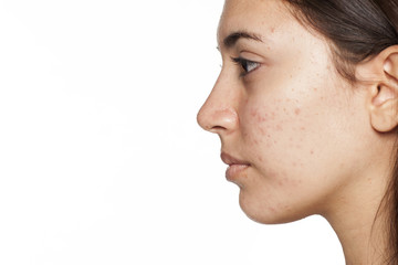profile of young girl with acne on white background