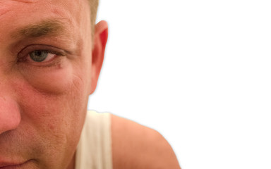 Red Swollen Watery Eye With White Background