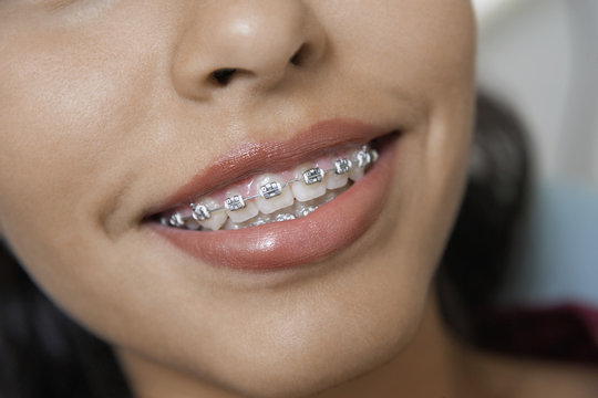 Close-up Of A Female Wearing Brackets In Teeth